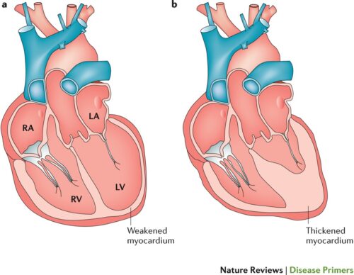 علائم نارسایی قلبی