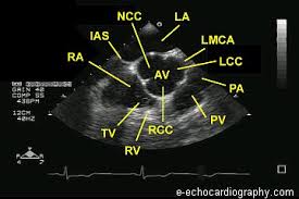 تصویر تشخیصی دریچه آئورت