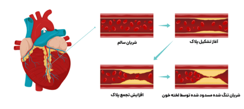اهمیت شناخت سخت شدن رگ ها