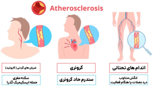 علائم تصلب شرایین