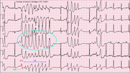 آریتمی قلبی