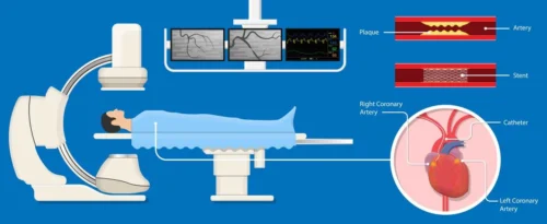 مراحل آنژیوگرافی
