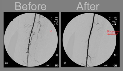 درمان با آنژیوپلاستی